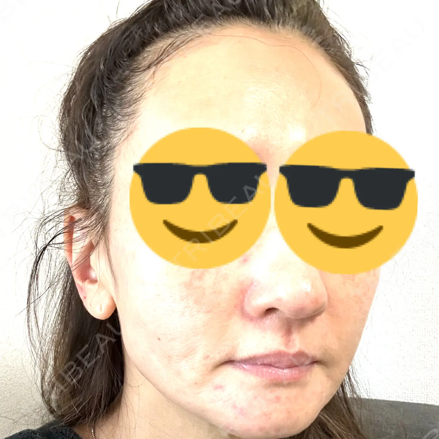 施術後の写真