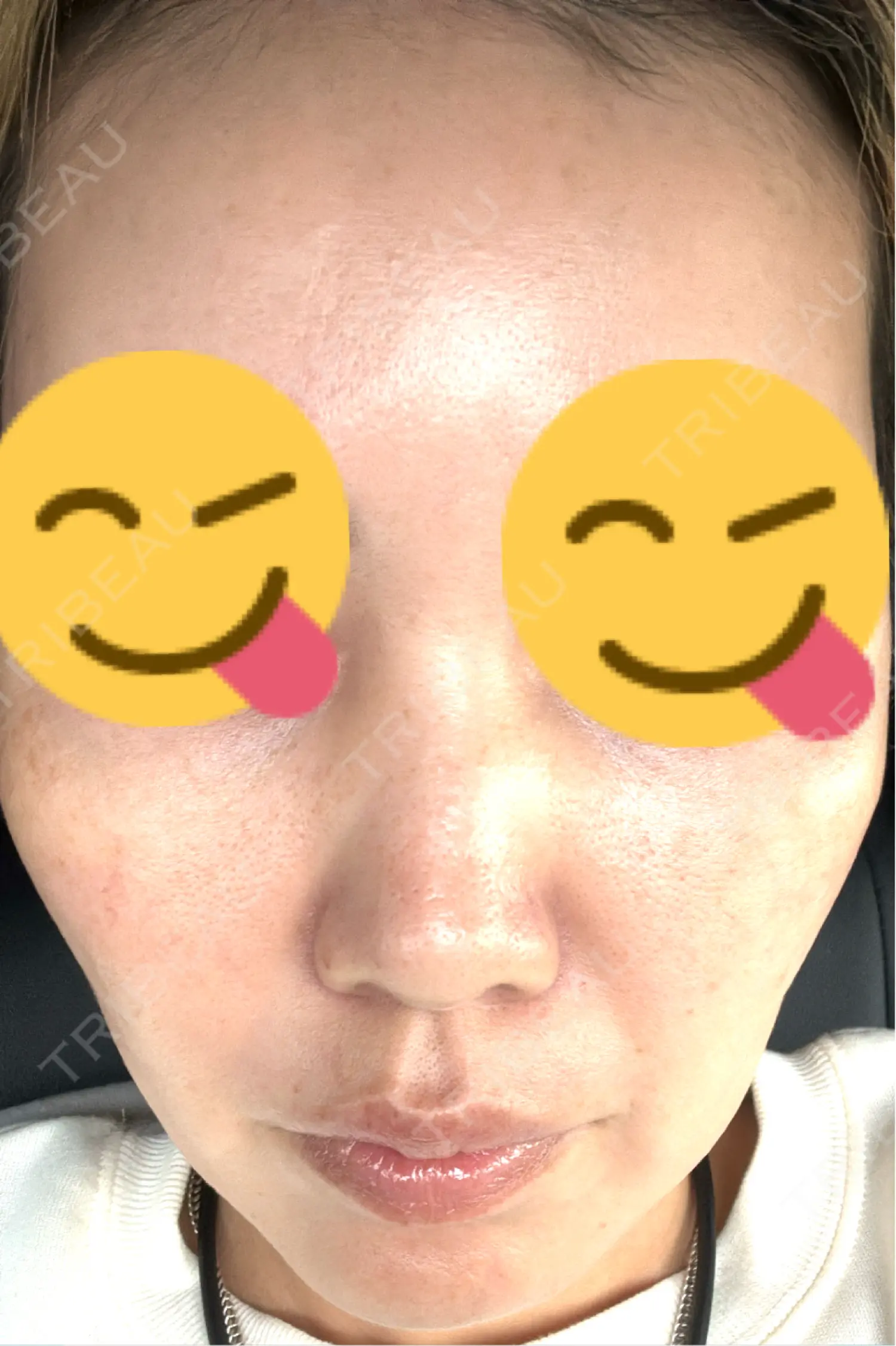 施術後の写真