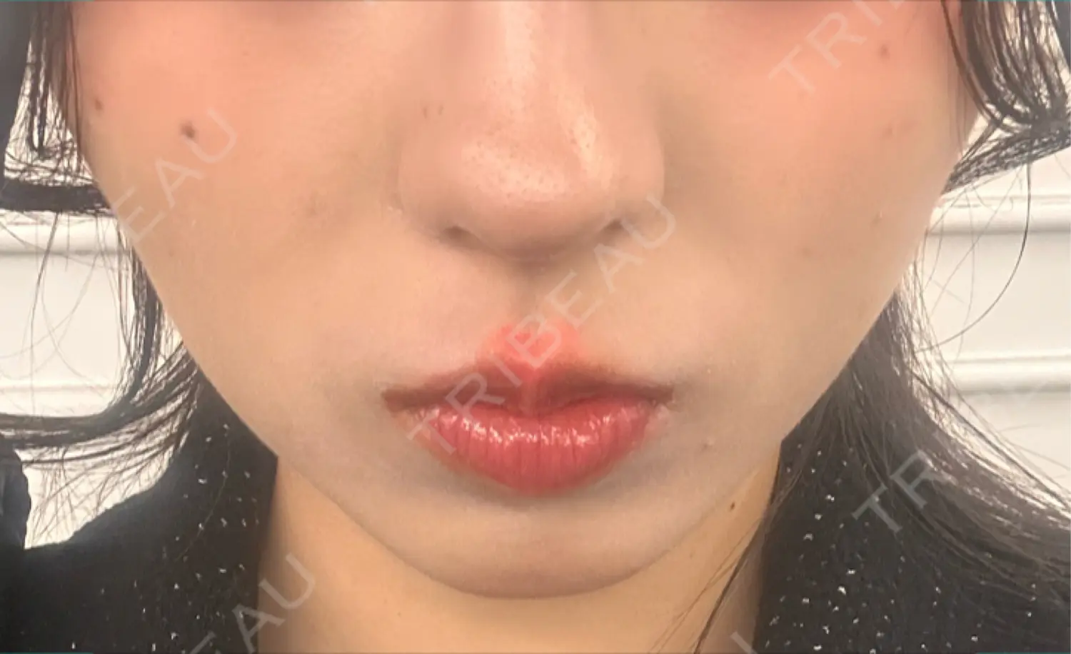 施術後の写真