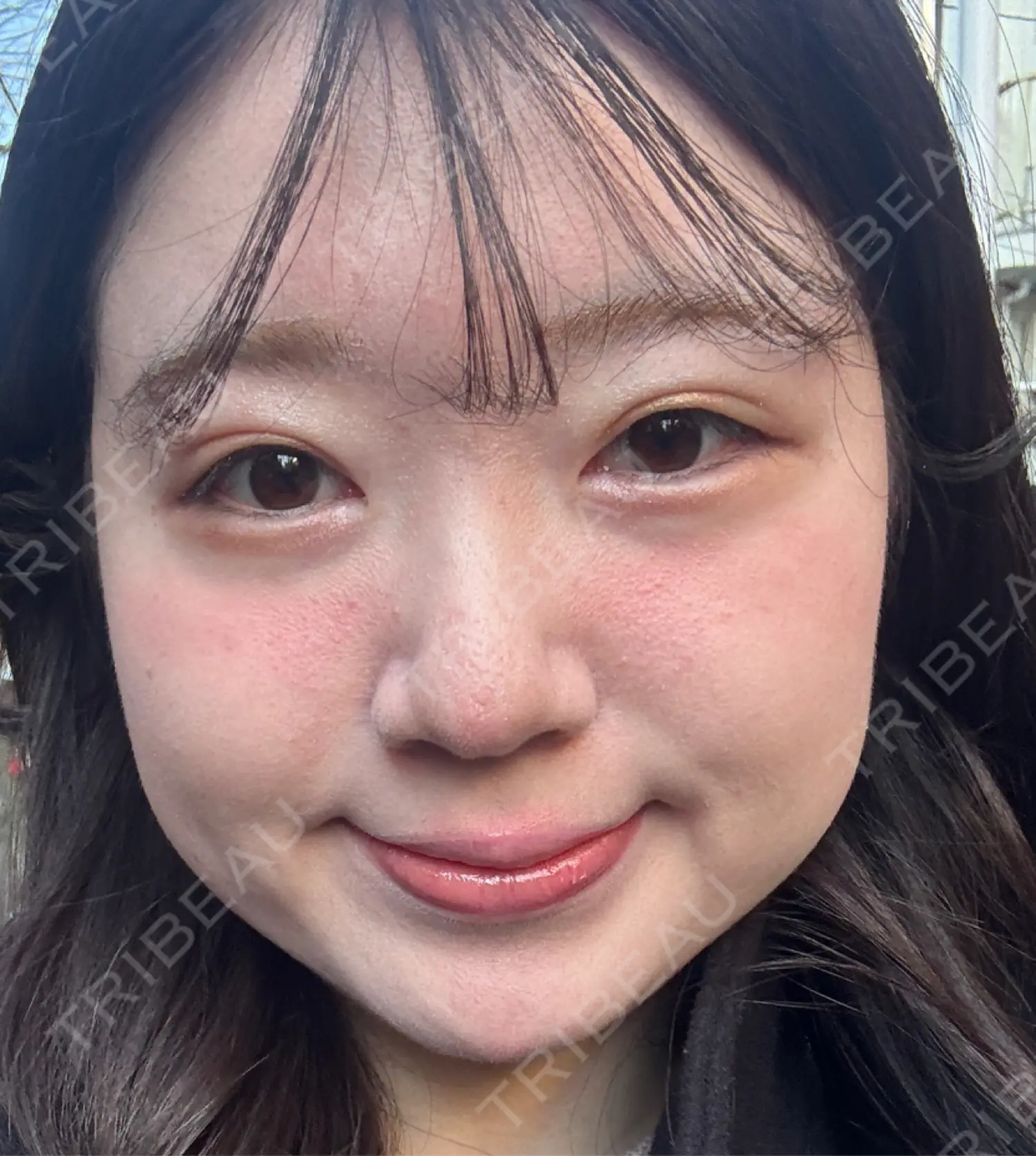 施術後の写真