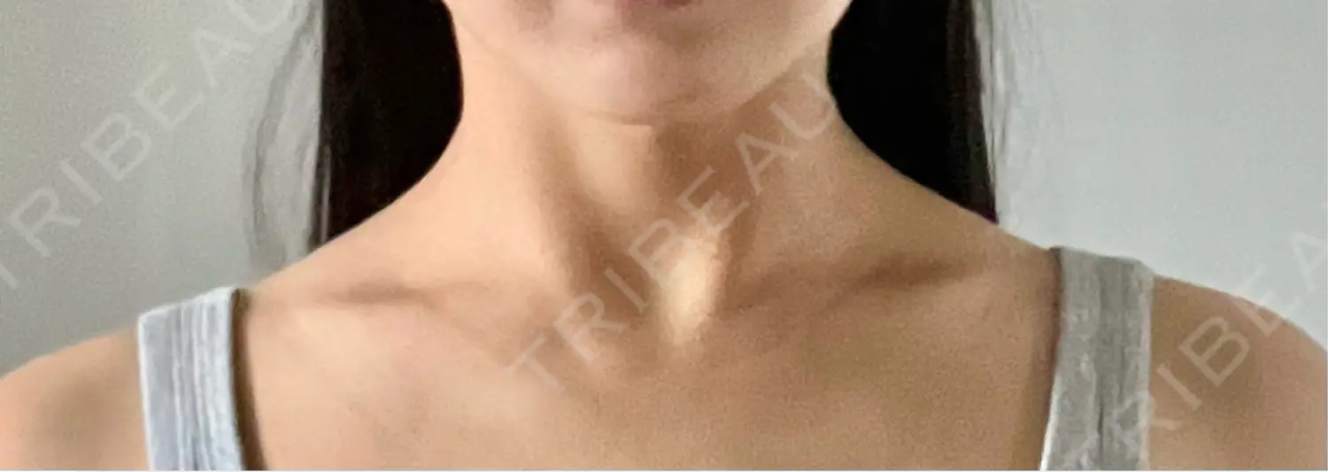 施術後の写真