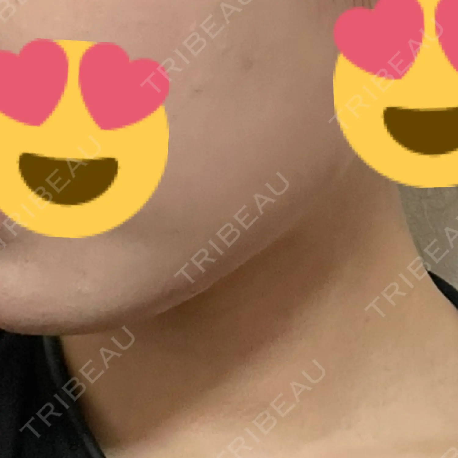 施術後の写真