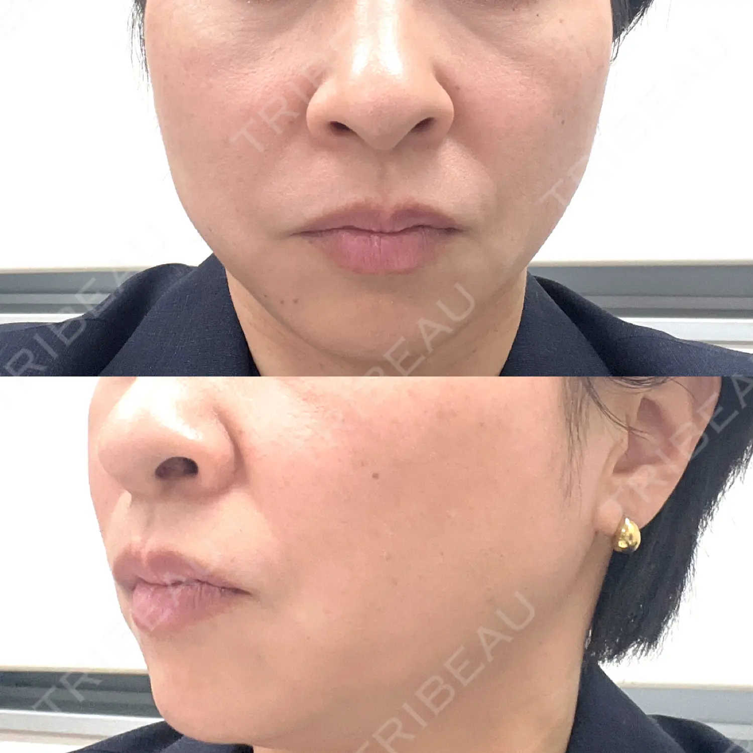 施術後の写真