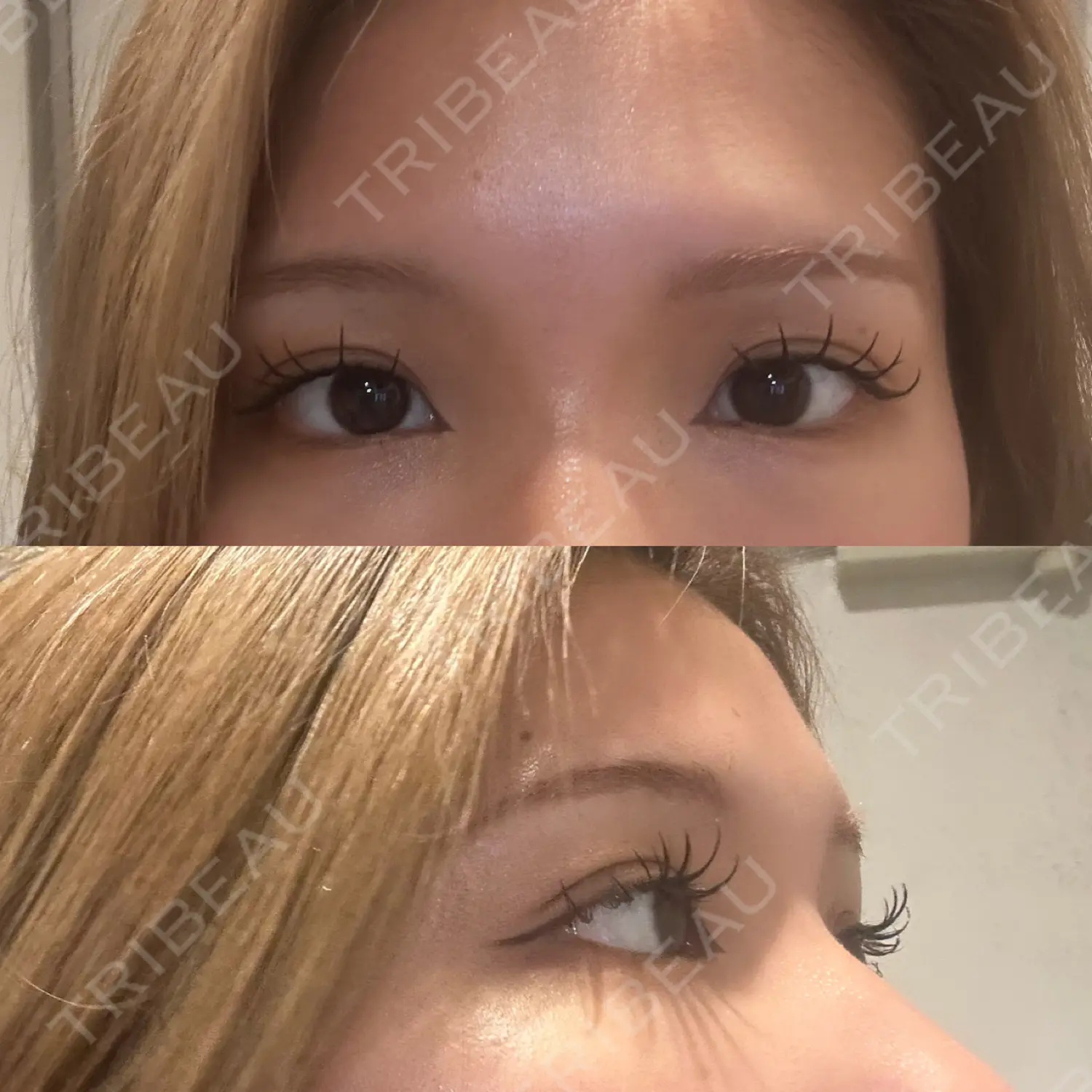 施術後の写真