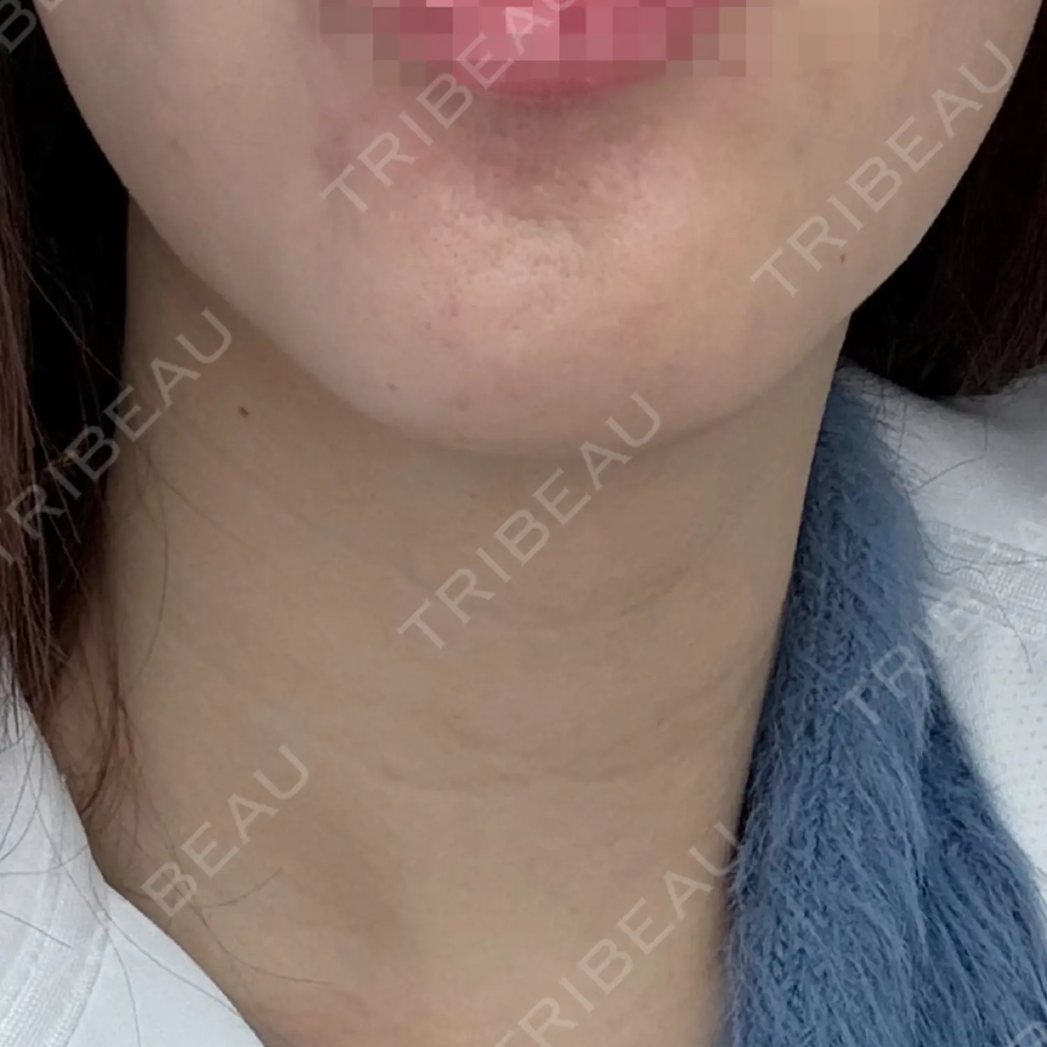 施術後の写真