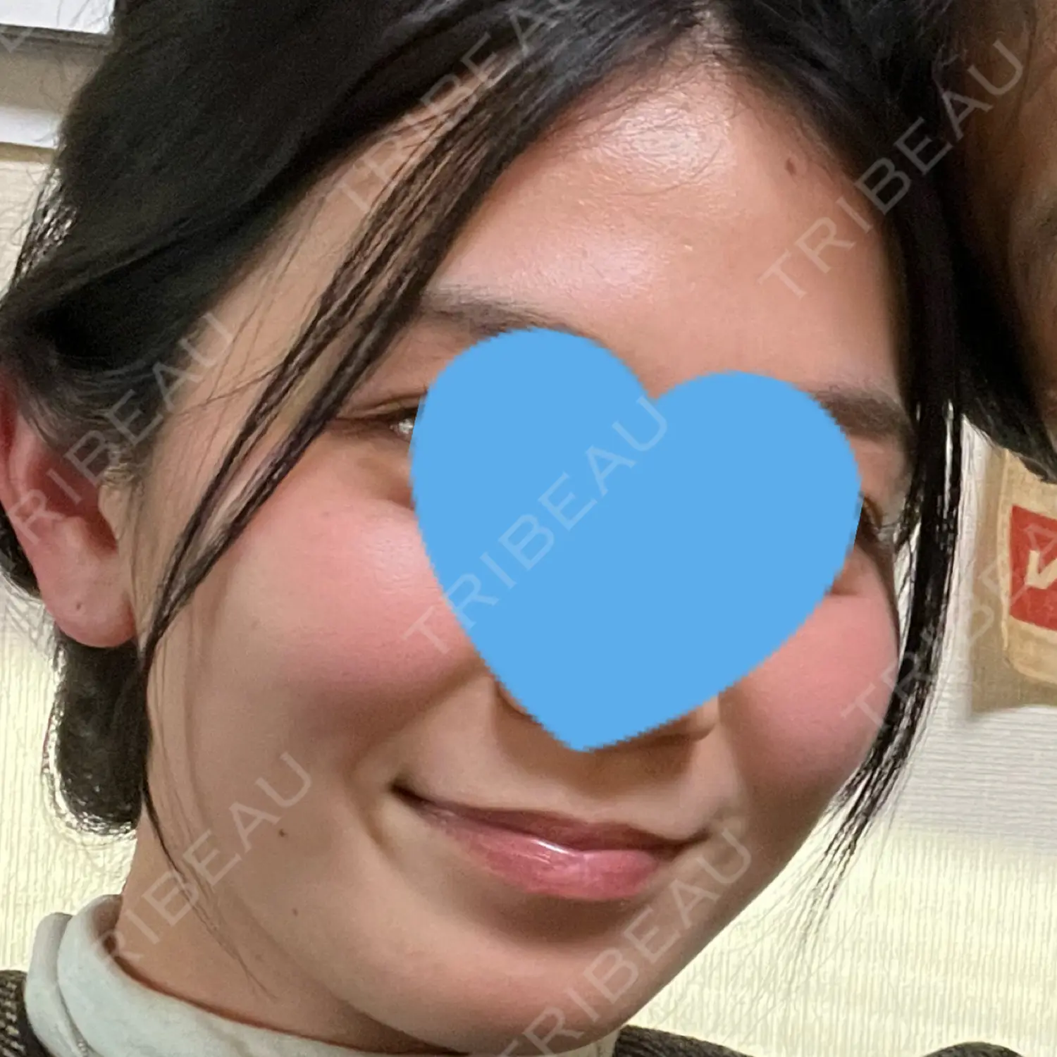 施術後の写真