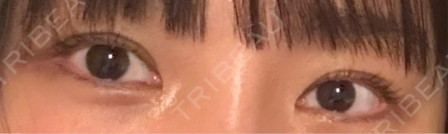 施術後の写真