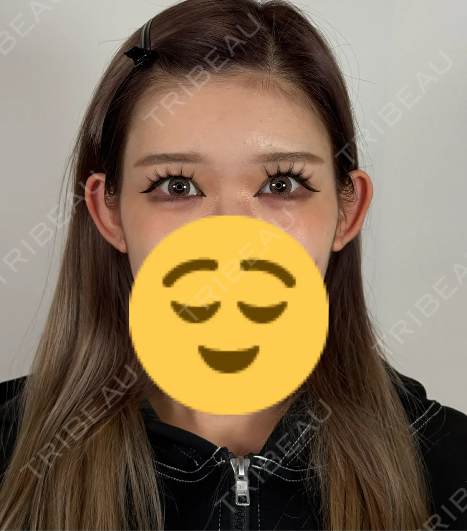 施術後の写真