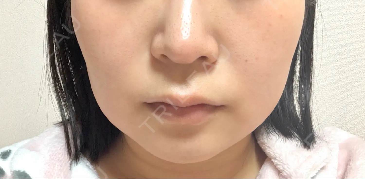 施術後の写真