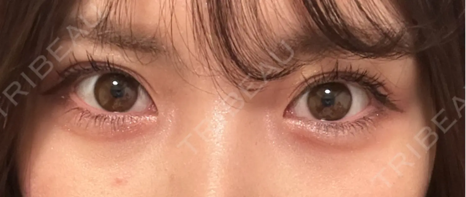 施術後の写真