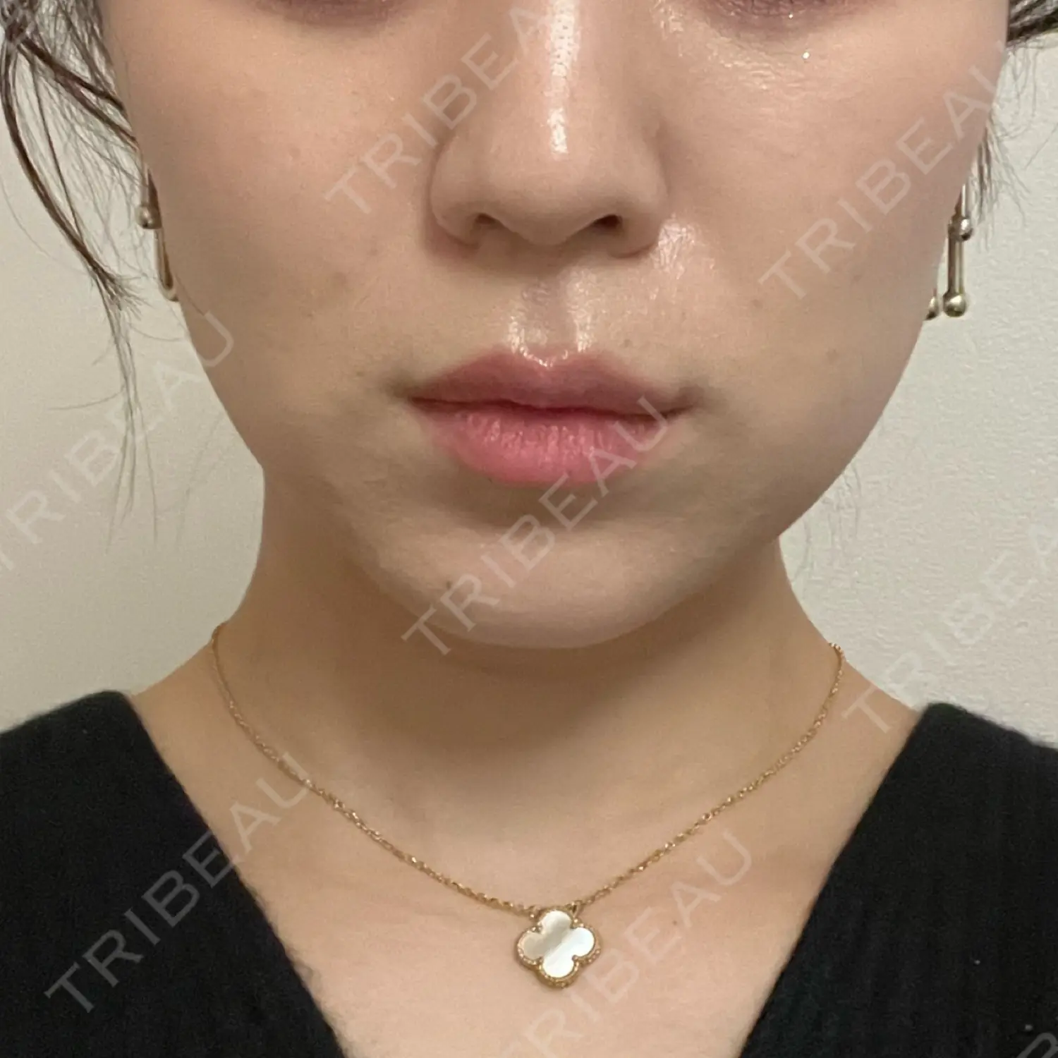 施術後の写真