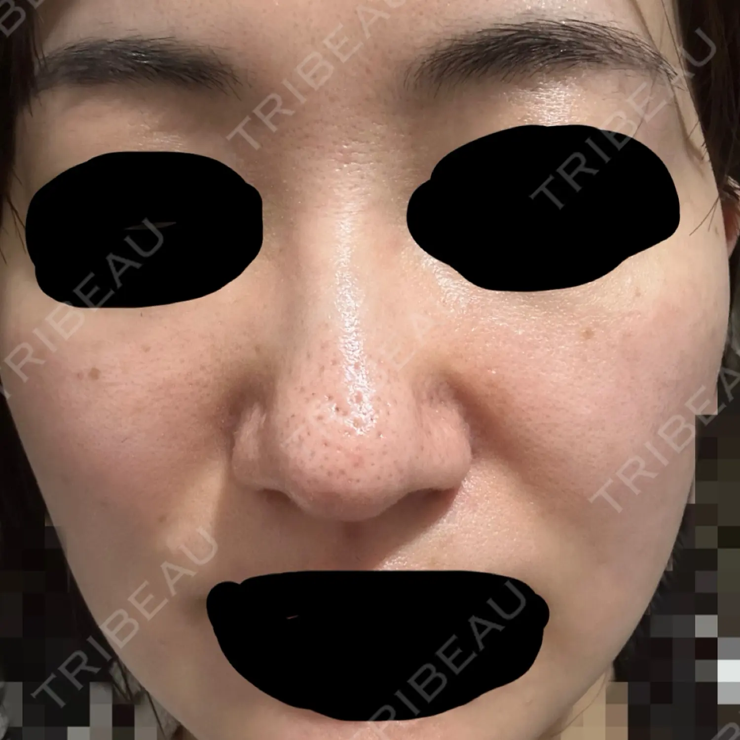 施術後の写真