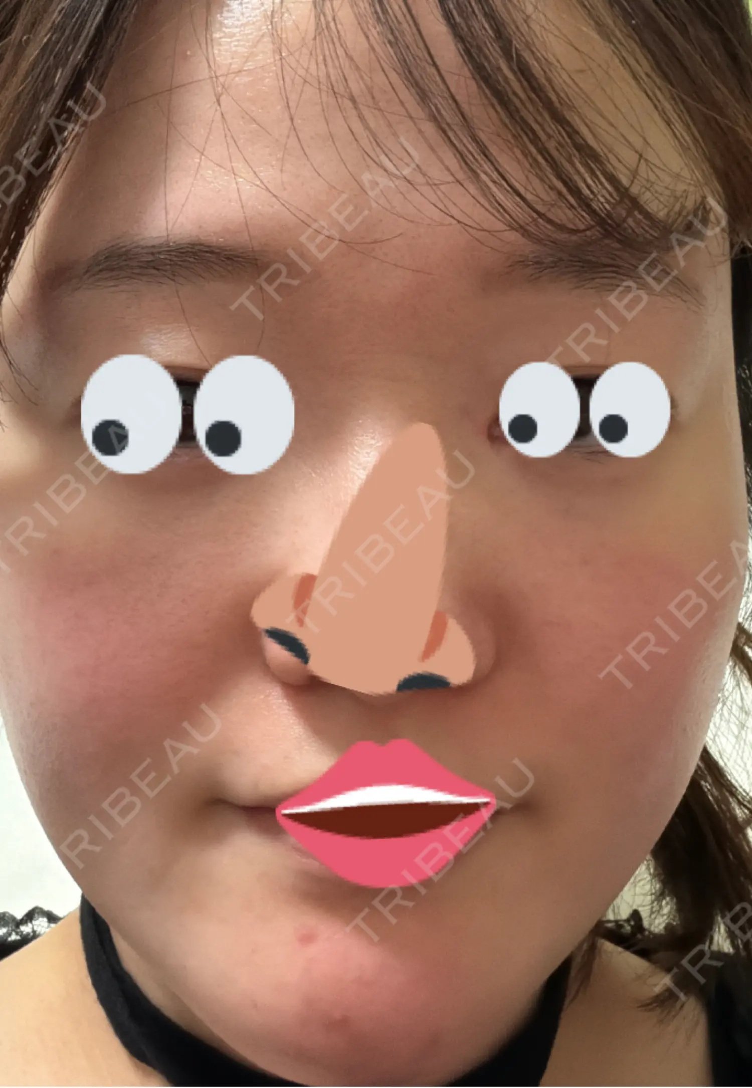 施術後の写真