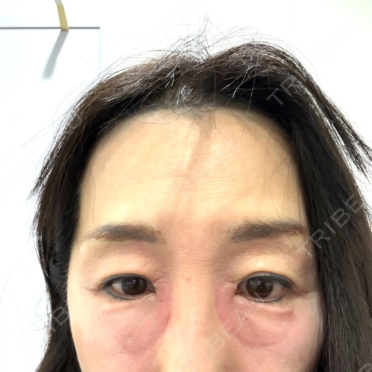 施術後の写真