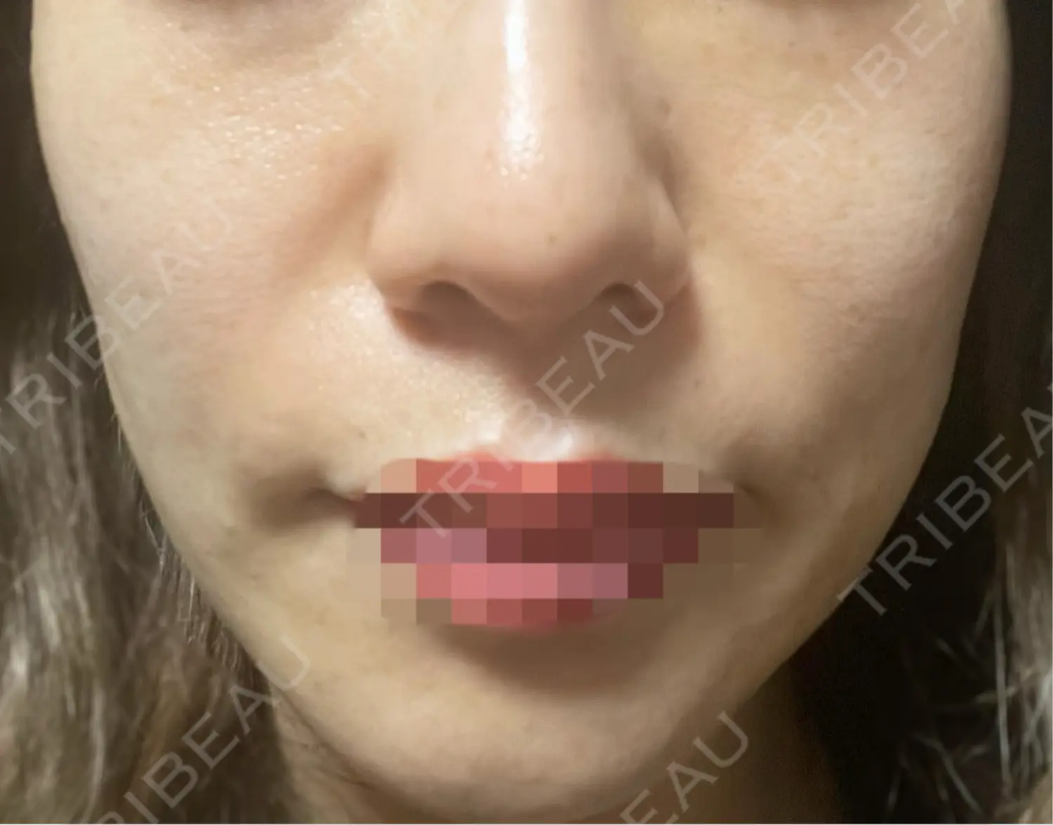 施術後の写真