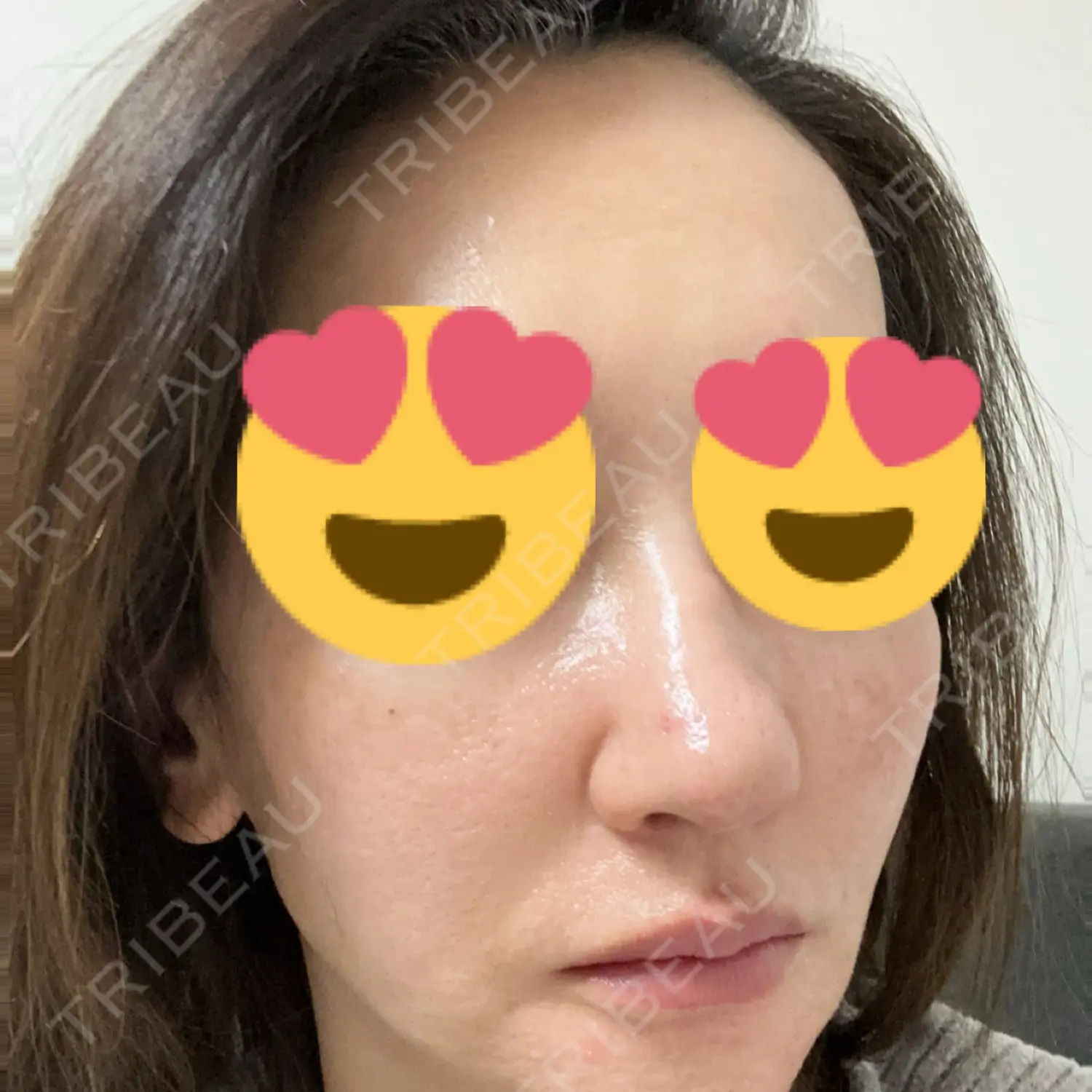 施術後の写真