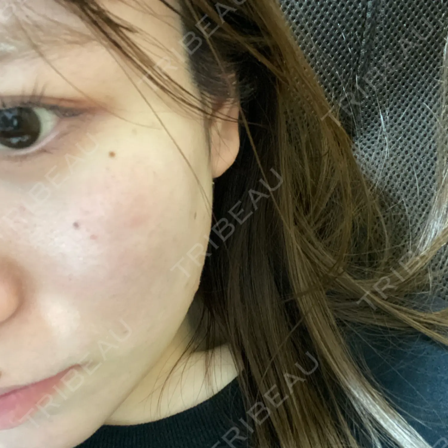 施術後の写真