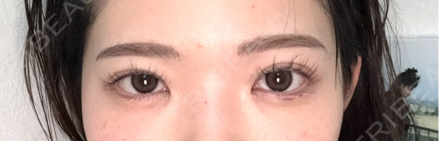 施術後の写真