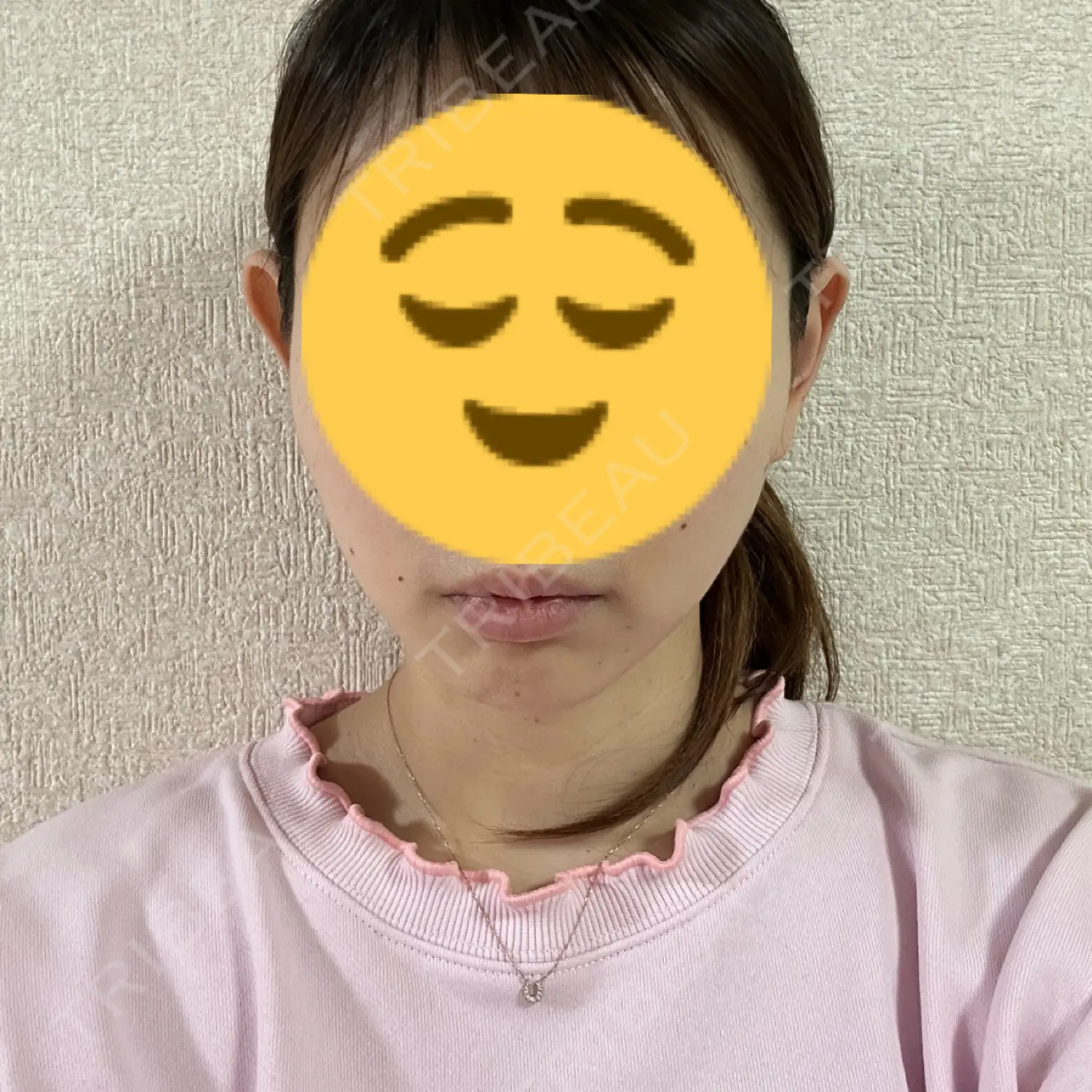 施術後の写真