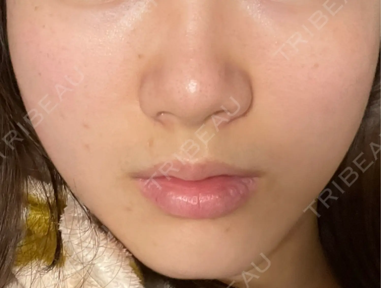 施術後の写真