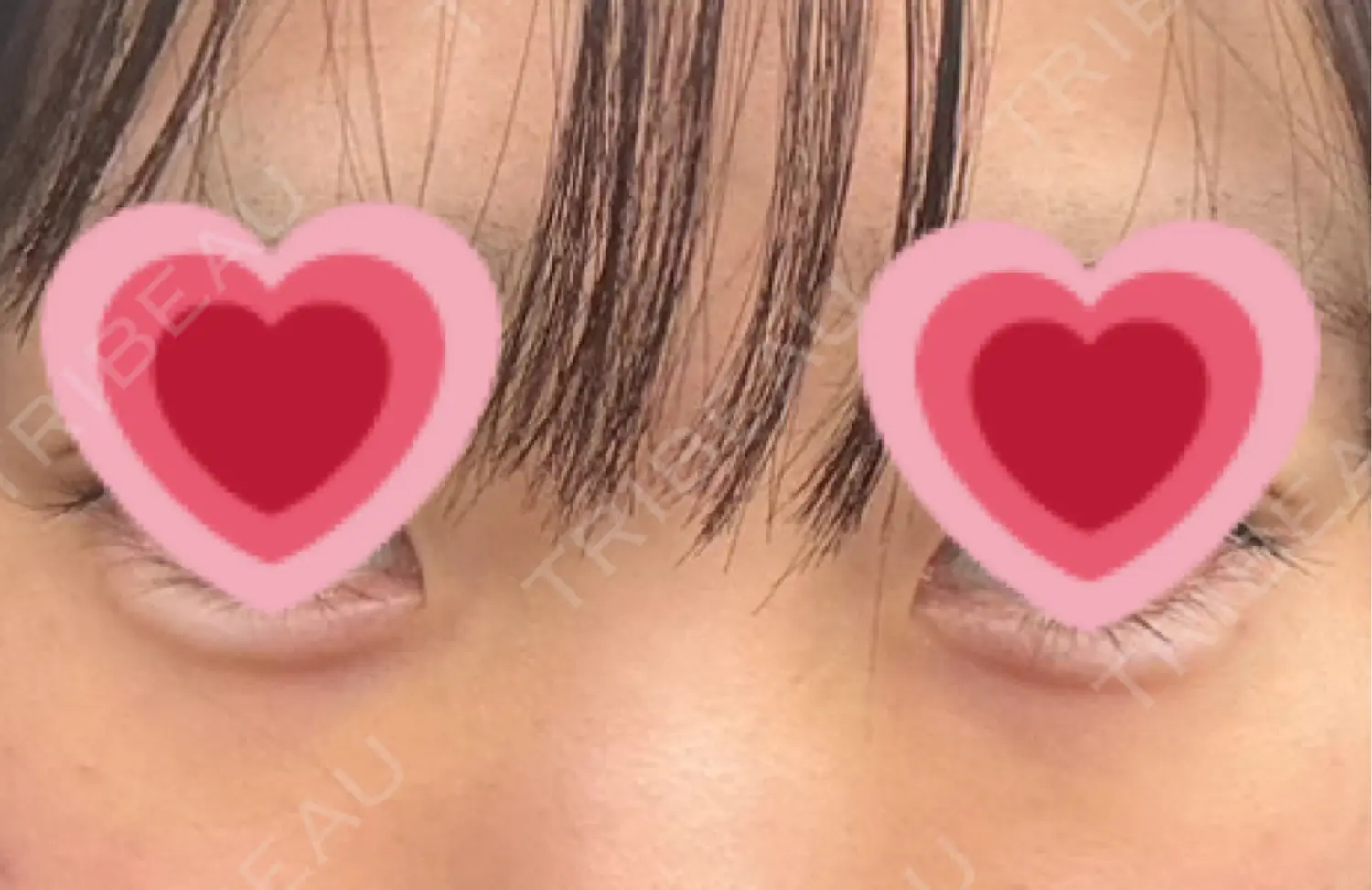 施術後の写真