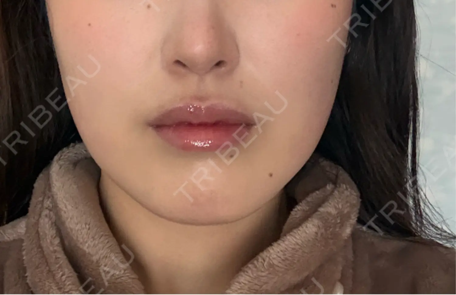 施術後の写真