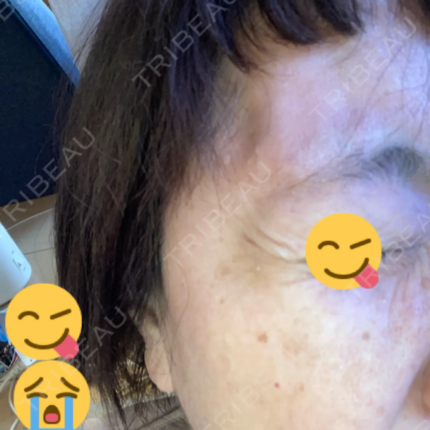 施術後の写真