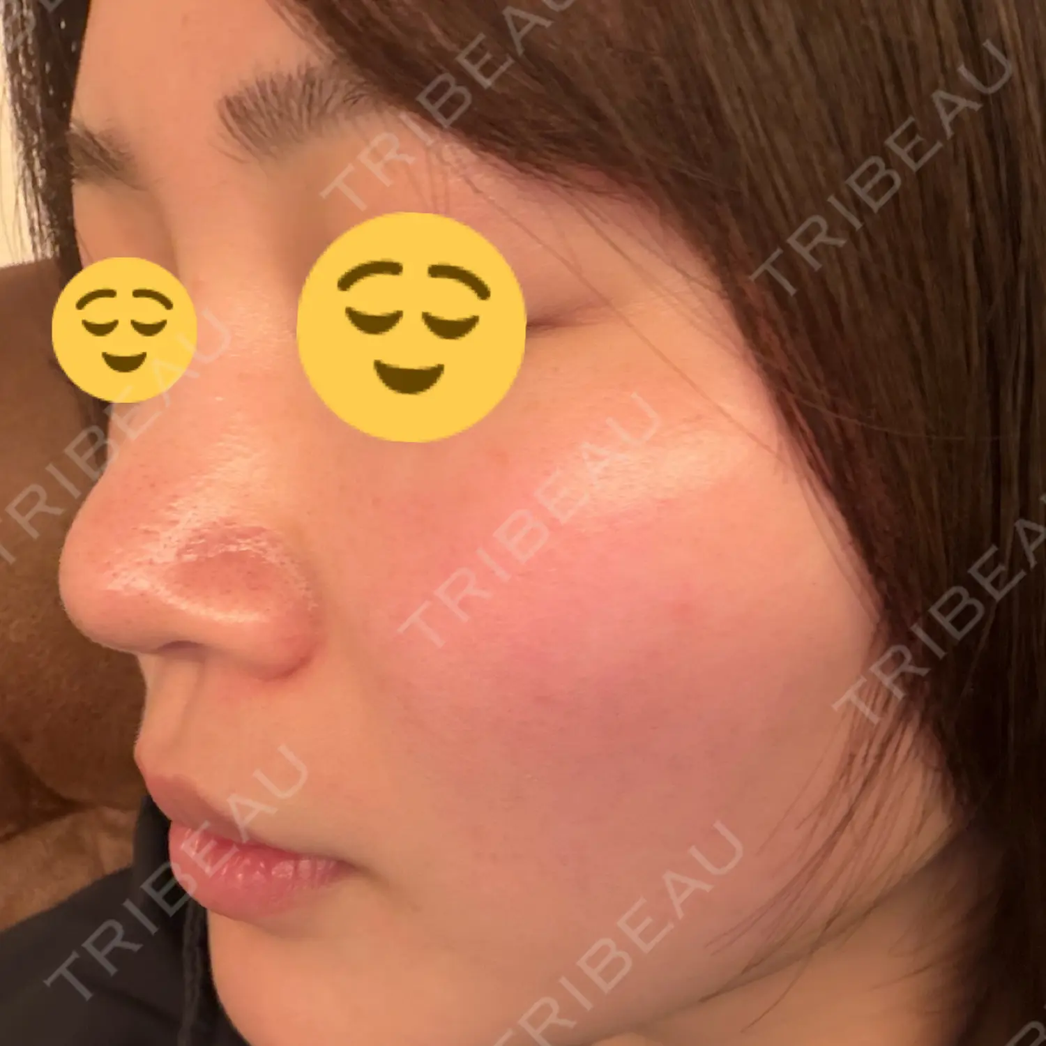 施術後の写真