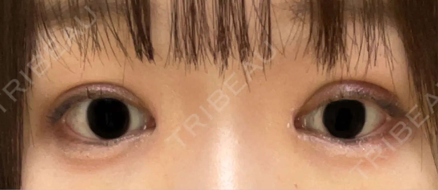 施術後の写真
