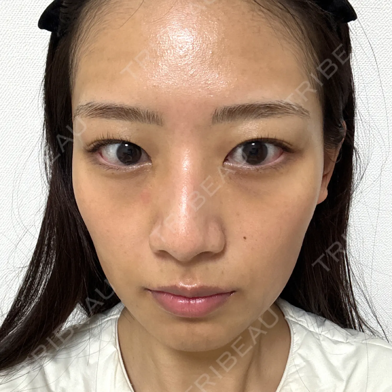 施術後の写真