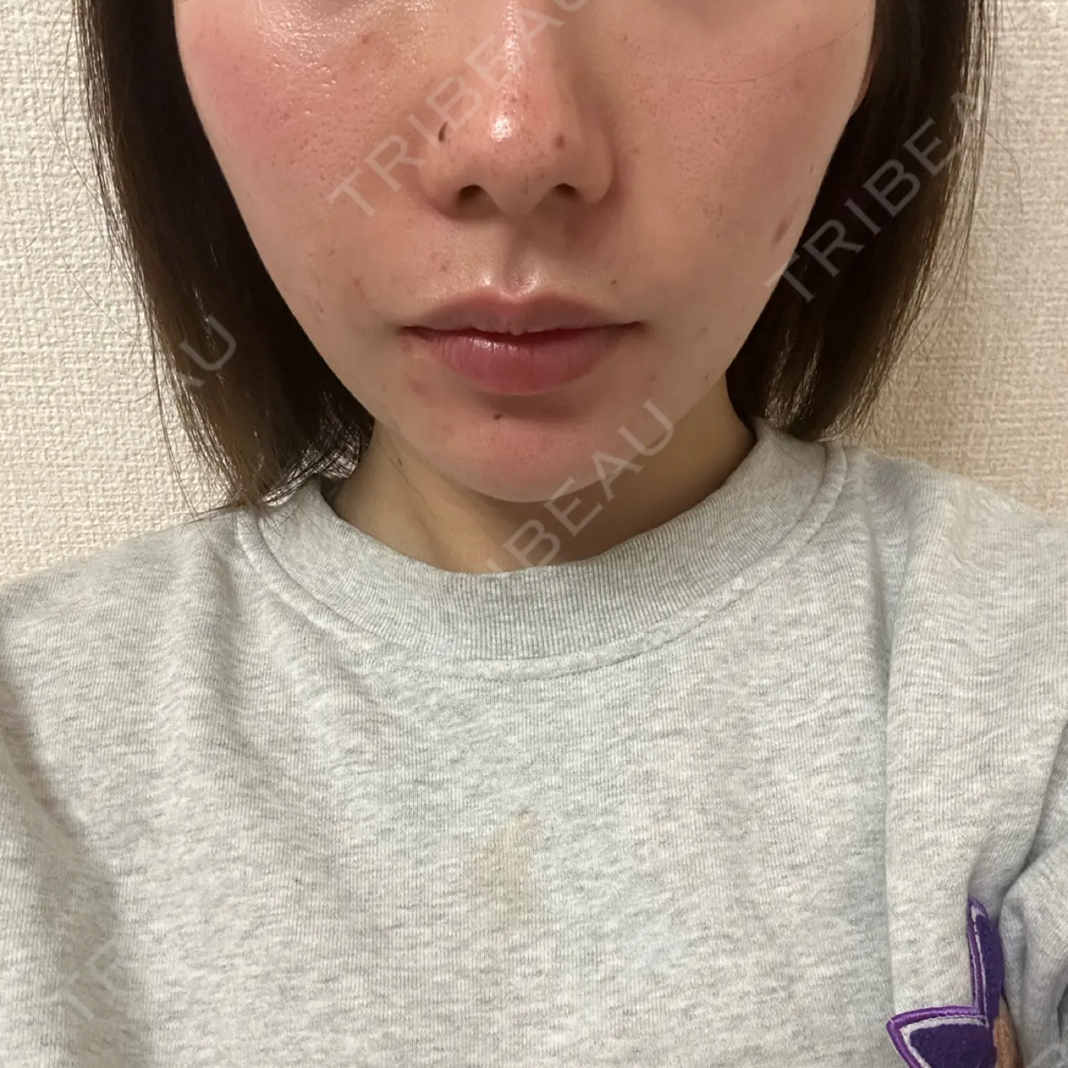 施術後の写真