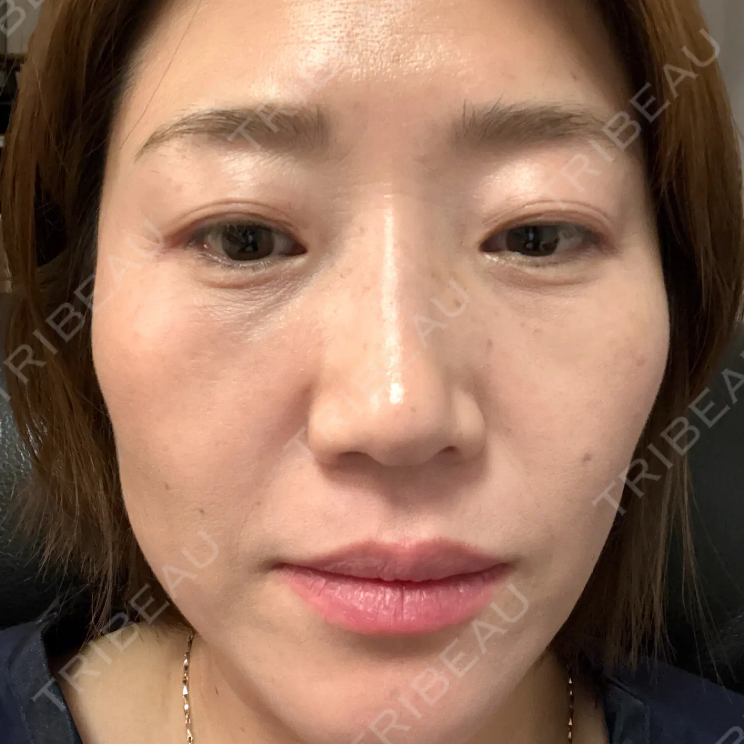 施術後の写真