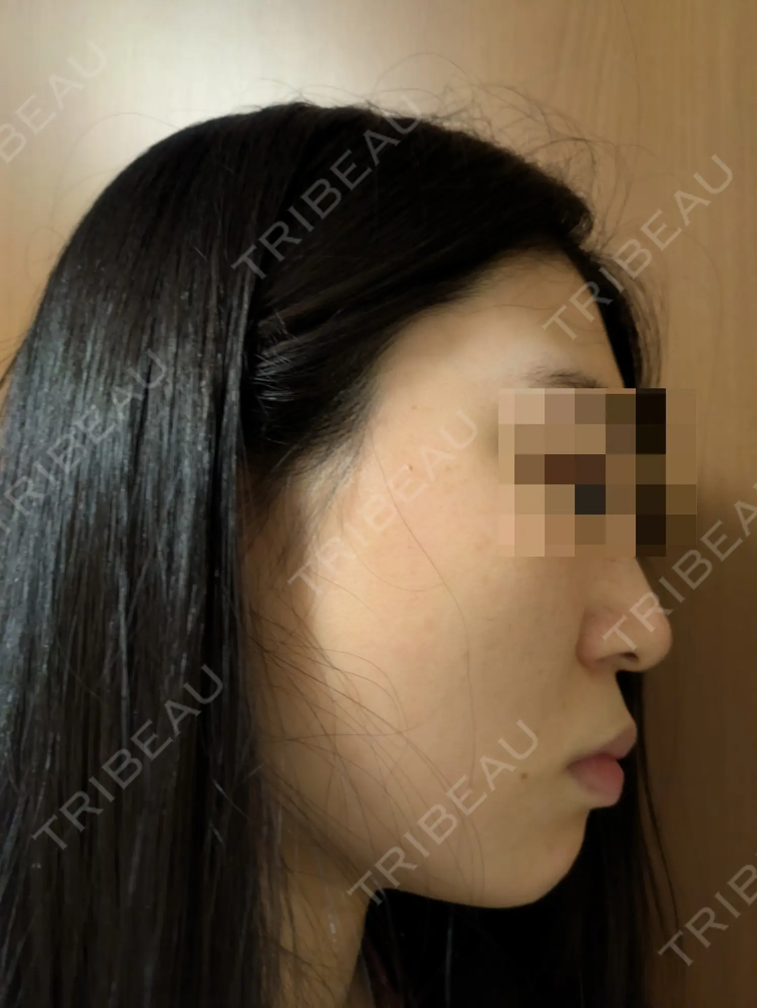施術後の写真