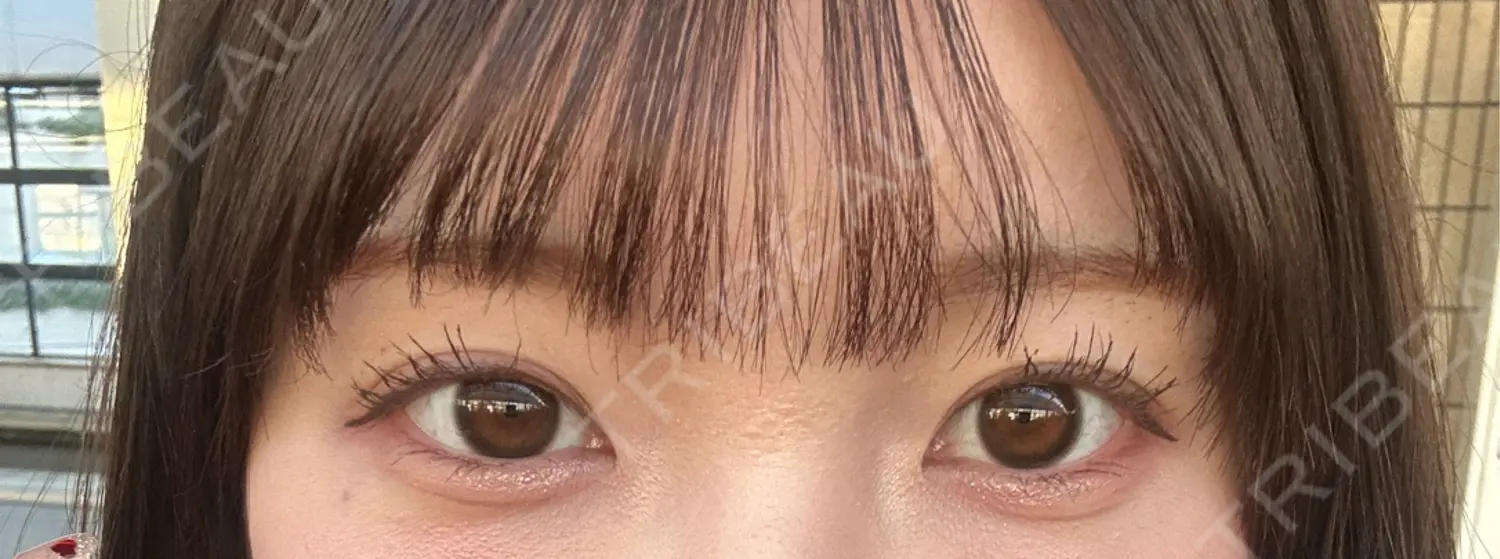 施術後の写真