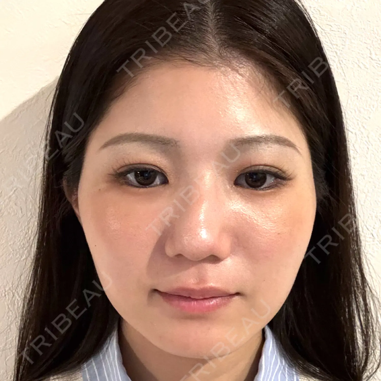 施術後の写真
