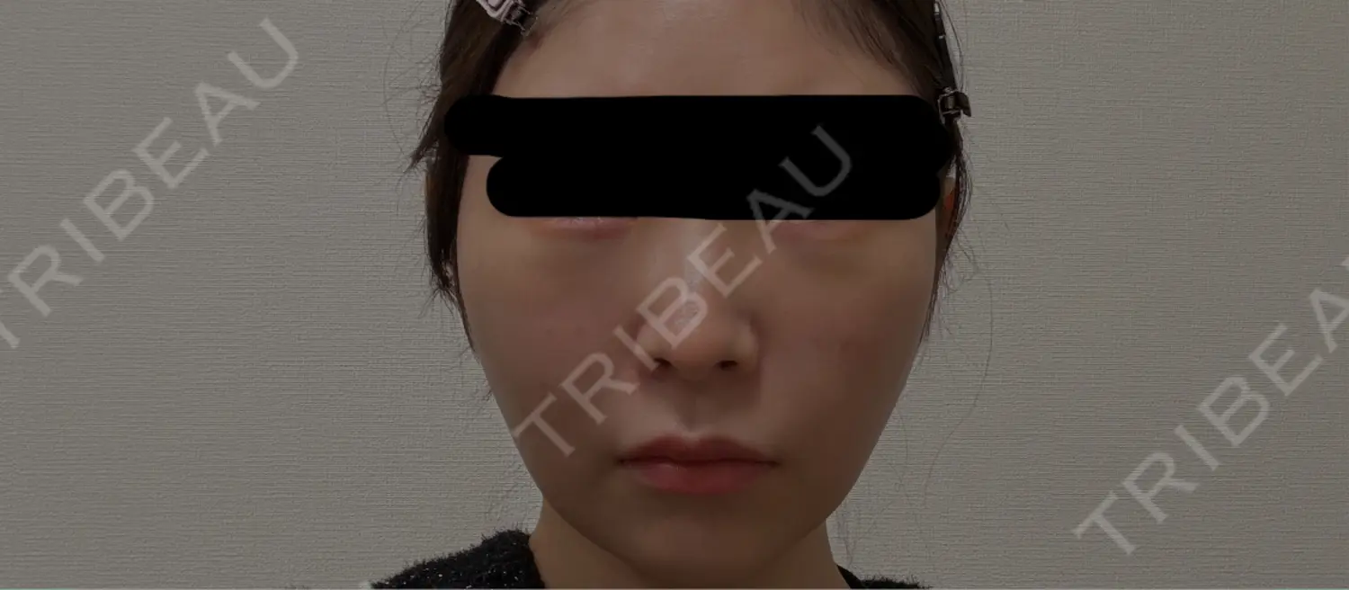 施術後の写真