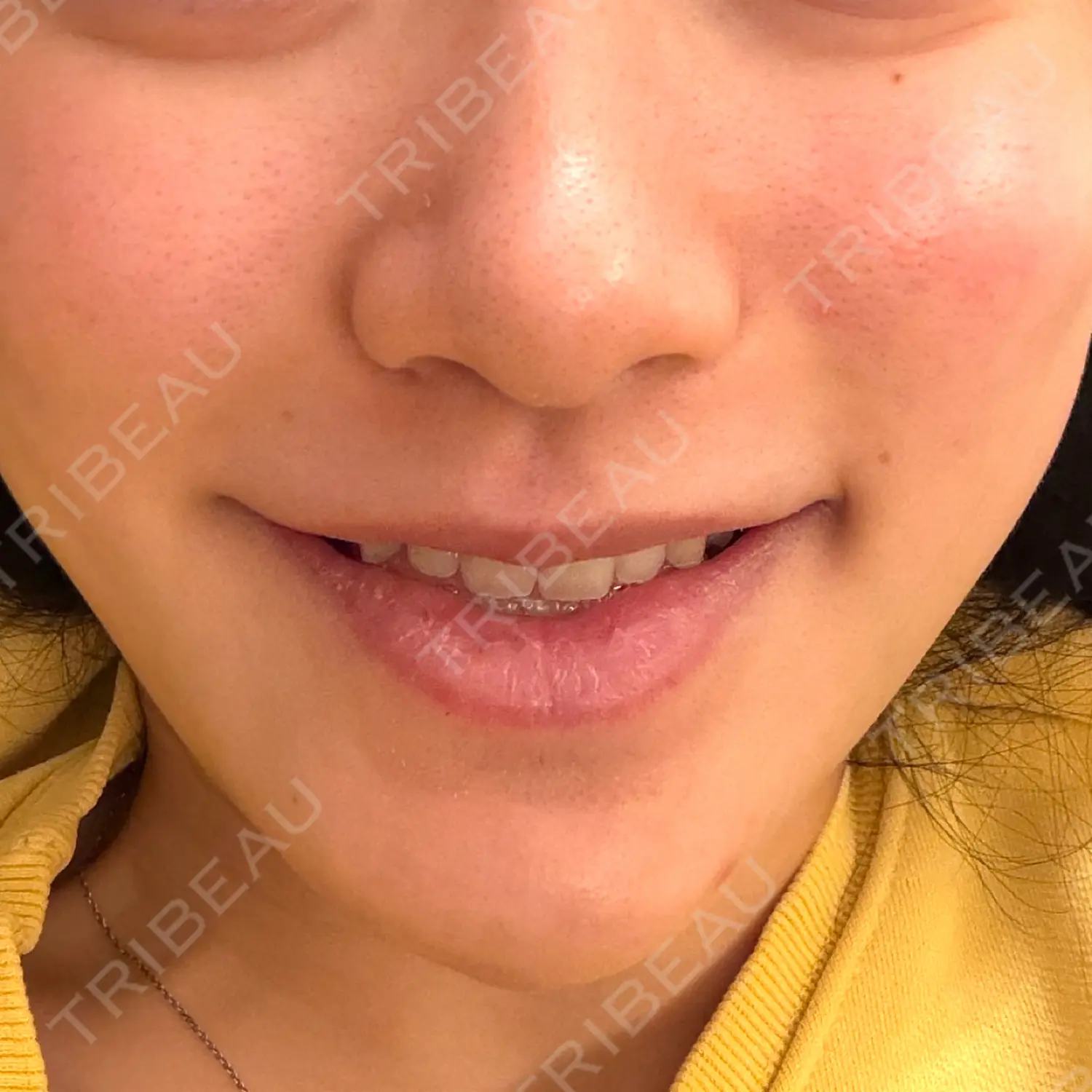 施術後の写真