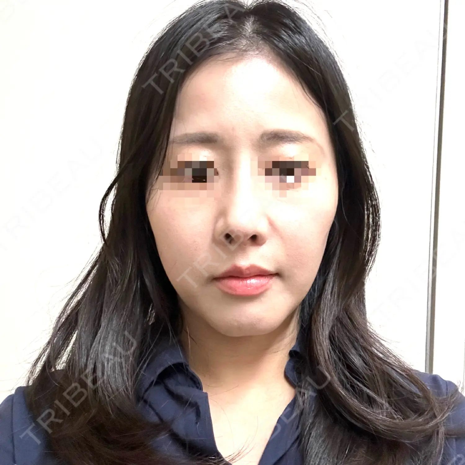 施術後の写真