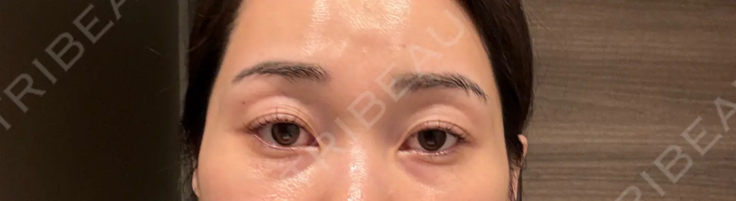 施術後の写真