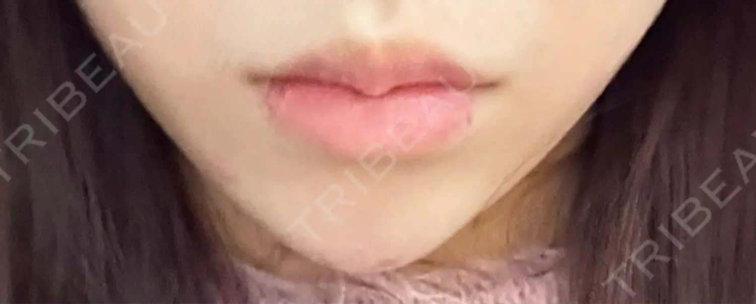 施術後の写真