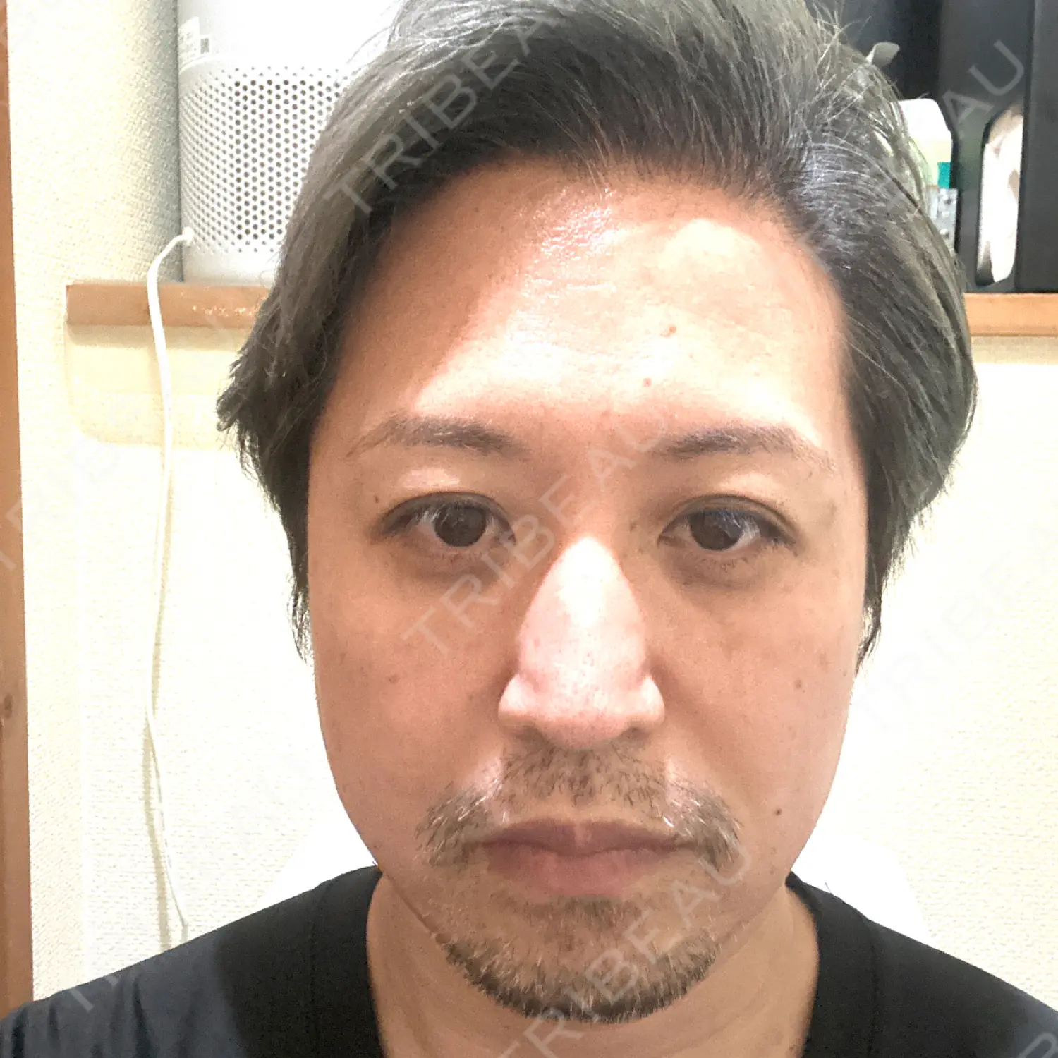 施術後の写真
