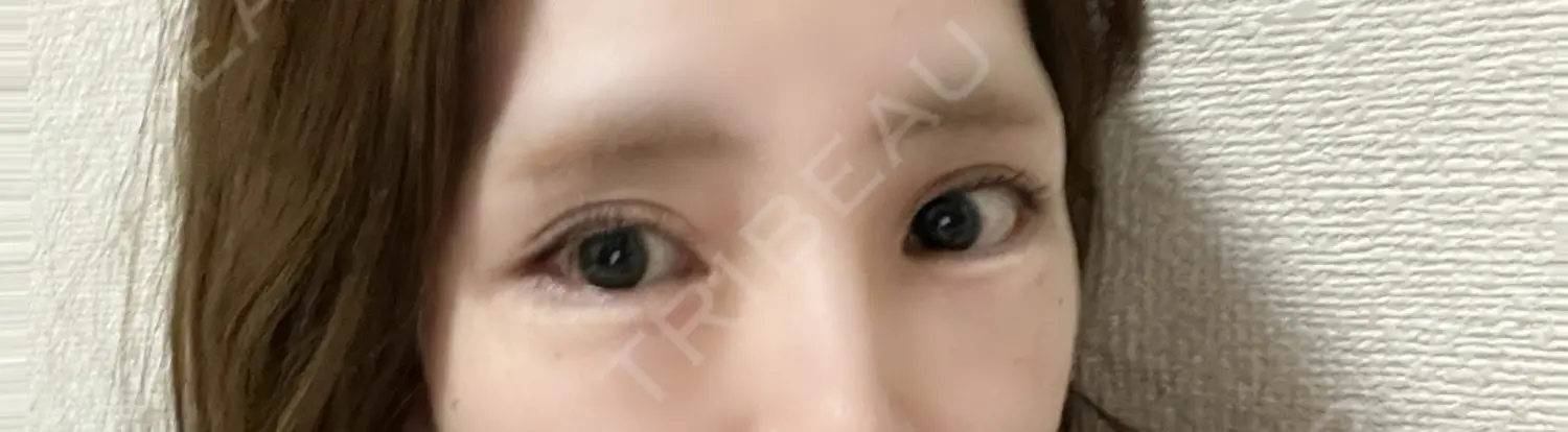 施術後の写真