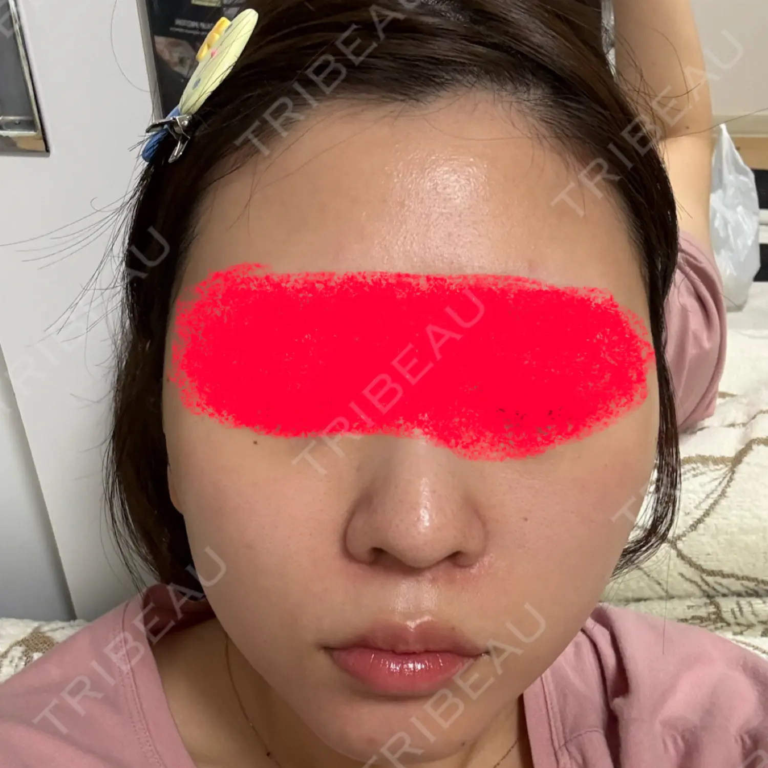 施術後の写真