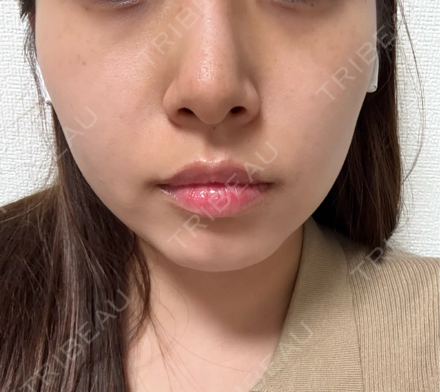 施術後の写真
