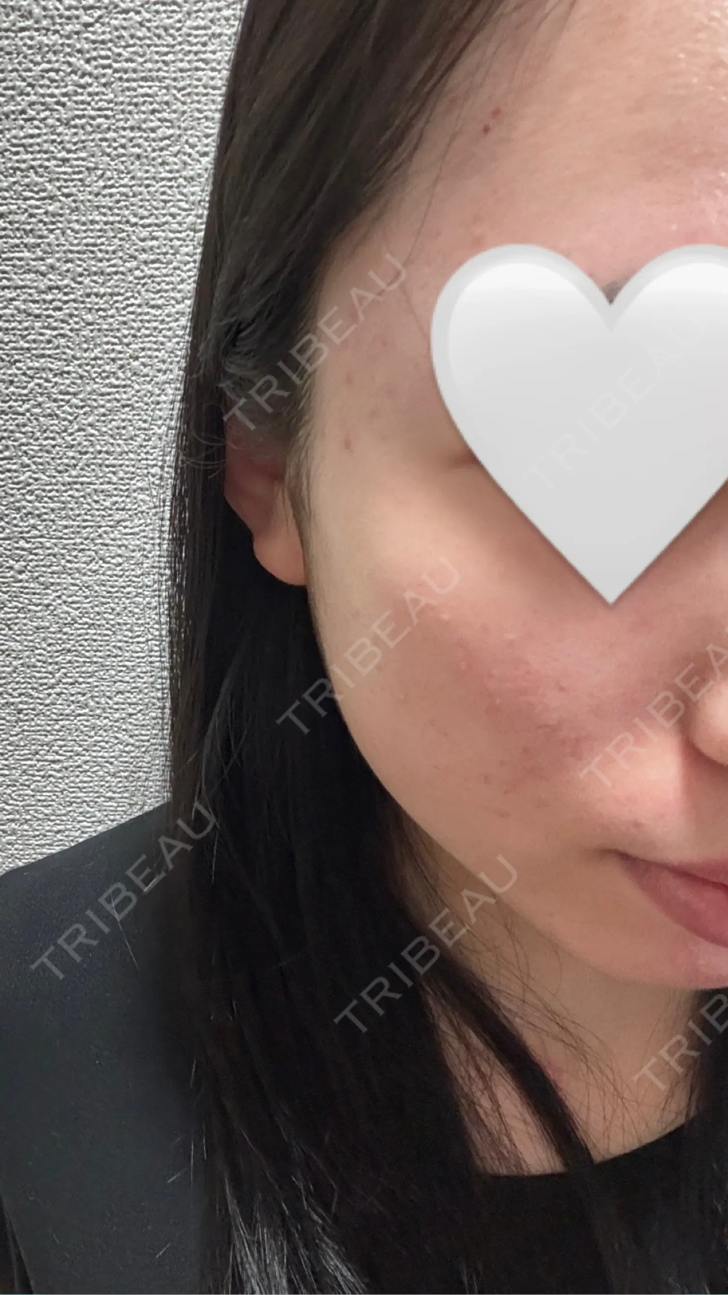 施術後の写真
