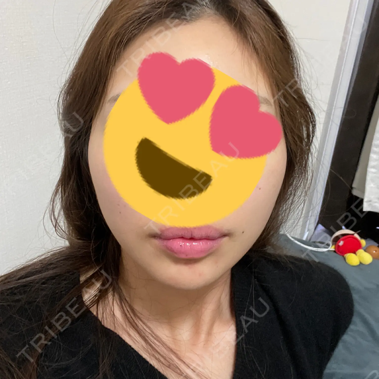 施術後の写真