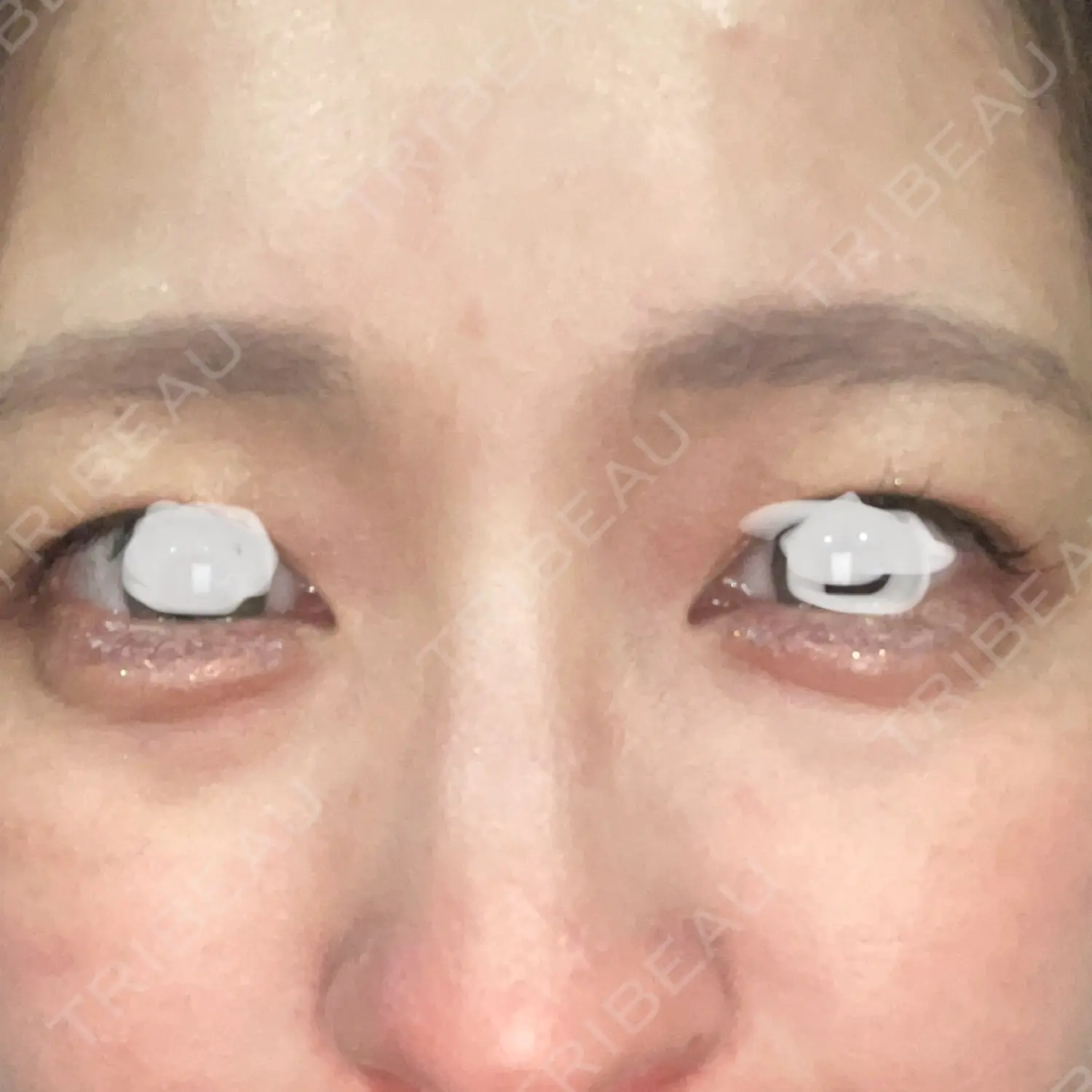 施術後の写真