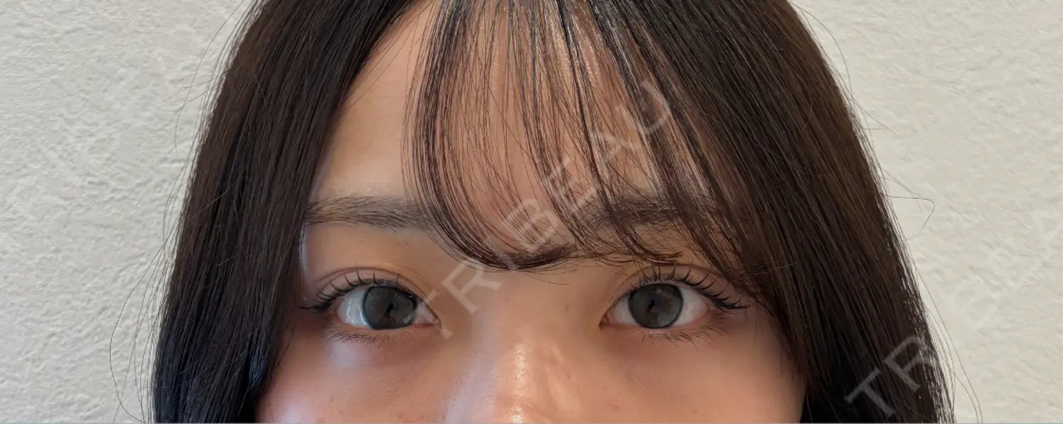 施術後の写真