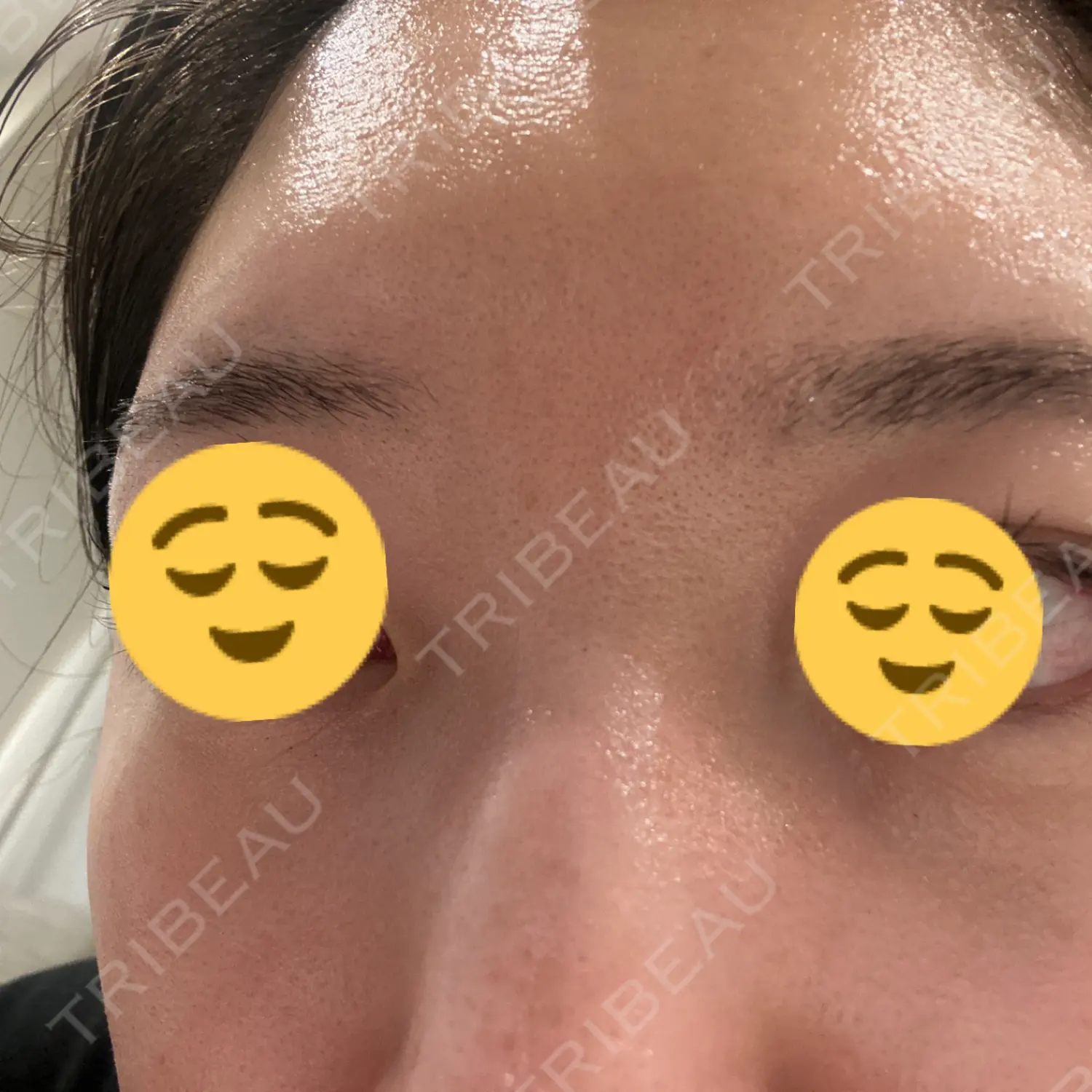 施術後の写真