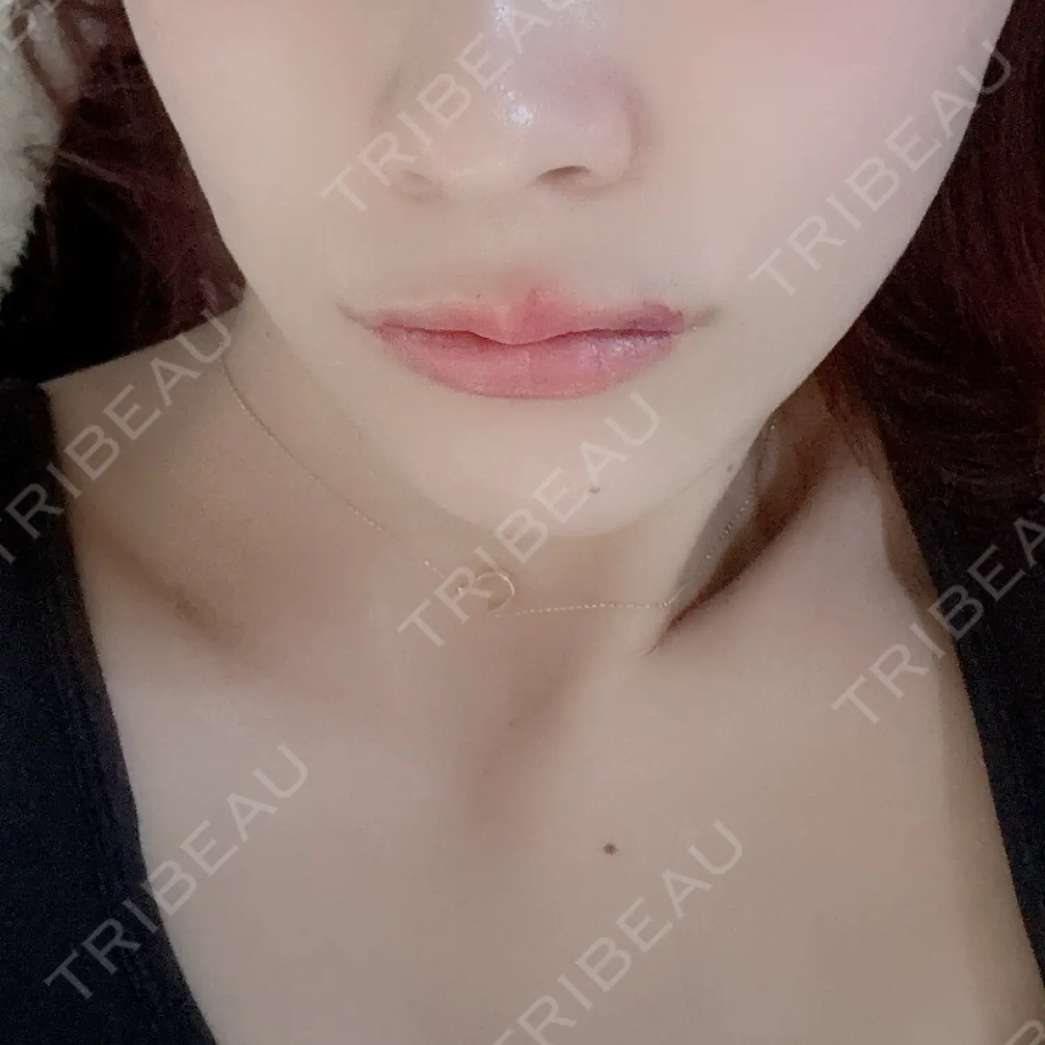 施術後の写真